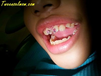 molar teeth 1